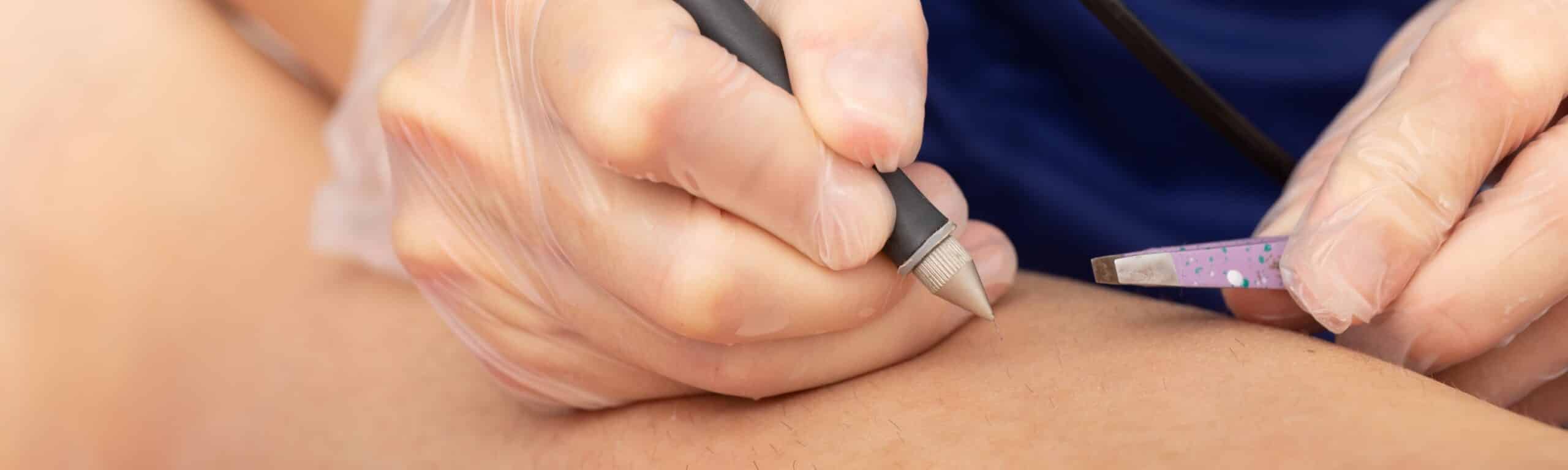 Epilation définitive