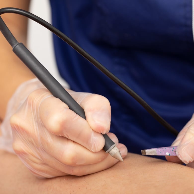 Epilation définitive